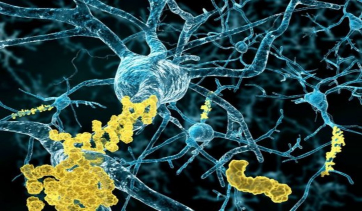 Alzheimer – Une étude de cas révèle comment le déclin cognitif peut être inversé